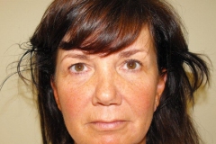 Band Aid Facelift Patient 10 Front Before