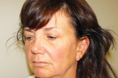 Band Aid Facelift Patient 10 Left Before