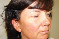 Band Aid Facelift Patient 10 Right Before