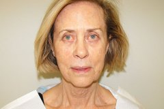 Band Aid Facelift Patient 11 Front Before