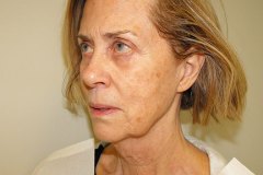 Band Aid Facelift Patient 11 Left Before