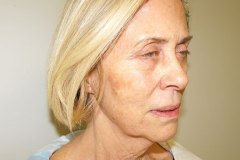 Band Aid Facelift Patient 11 Right Before