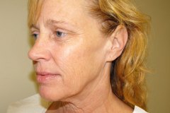 Band Aid Facelift Patient 12 Left Before