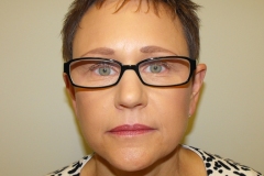 Band Aid Facelift Patient 7 Front After