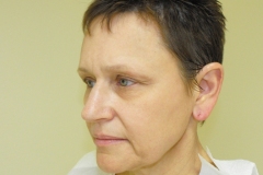 Band Aid Facelift Patient 7 Left Before