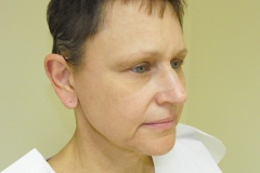 Band Aid Facelift Patient 7 Right Before