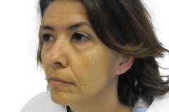 Band Aid Facelift Patient 8 Left Before