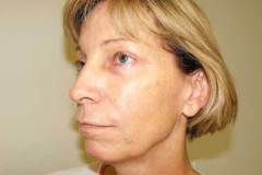 Band Aid Facelift Patient 9 Left Before