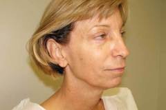 Band Aid Facelift Patient 9 Right Before