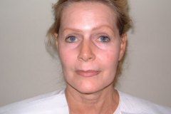 Band Aid Facelift Patient 2 Front Before