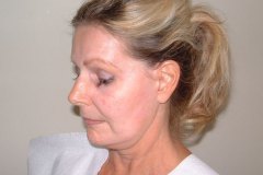 Band Aid Facelift Patient 2 Left Before