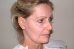 Band Aid Facelift Patient 2 Right Before