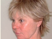 Band Aid Facelift Patient 5 Left Before