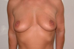 Breast Augmentation Patient 1 Front Before