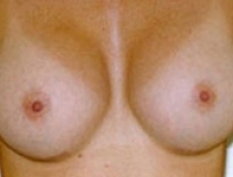 Breast Augmentation Patient 10 Front After