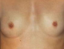 Breast Augmentation Patient 10 Front Before