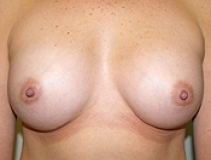 Breast Augmentation Patient 11 Front After
