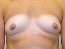 Breast Augmentation Patient 11 Front Before