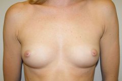 Breast Augmentation Patient 12 Front Before
