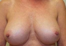 Breast Augmentation Patient 13 Front After