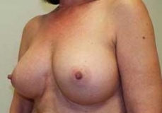 Breast Augmentation Patient 13 Left After