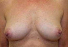 Breast Augmentation Patient 13 Front Before