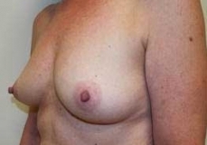 Breast Augmentation Patient 13 Left Before