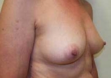 Breast Augmentation Patient 13 Right Before