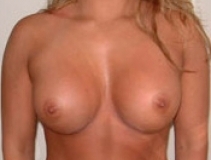 Breast Augmentation Patient 2 Front After