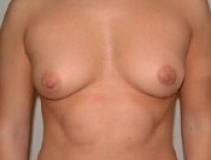 Breast Augmentation Patient 2 Front Before