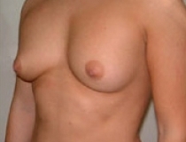 Breast Augmentation Patient 2 Left Before