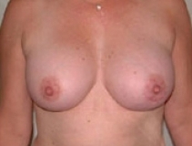 Breast Augmentation Patient 3 Front After