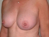 Breast Augmentation Patient 3 Left After