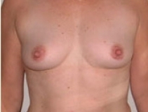 Breast Augmentation Patient 3 Front Before