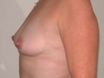 Breast Augmentation Patient 3 Left Before