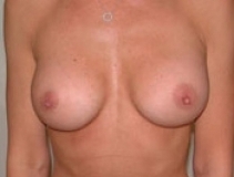 Breast Augmentation Patient 4 Front After