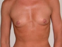 Breast Augmentation Patient 4 Front Before