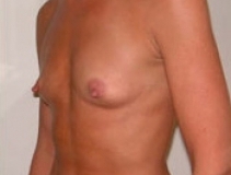 Breast Augmentation Patient 4 Left Before