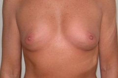 Breast Augmentation Patient 5 Front Before