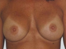 Breast Augmentation Patient 6 Front After