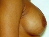 Breast Augmentation Patient 7 Right After