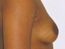 Breast Augmentation Patient 7 Right Before