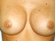 Breast Augmentation Patient 8 Front After