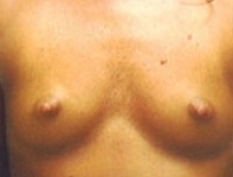 Breast Augmentation Patient 8 Front Before