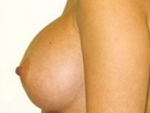 Breast Augmentation Patient 9 Left After