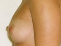 Breast Augmentation Patient 9 Left Before