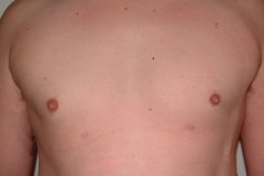 Gynecomastia Patient 1 Front After