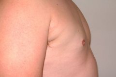 Gynecomastia Patient 1 Right After