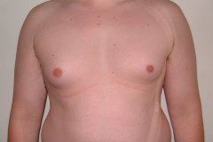 Gynecomastia Patient 1 Front Before