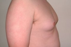 Gynecomastia Patient 1 Right Before